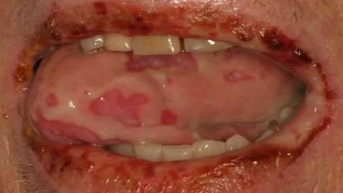 Hình 1. GVHD cấp tính ảnh hưởng đến khoang miệng với loét lan tỏa và đóng vảy ở môi và loét rộng ở mặt trong và mặt sau của lưỡi
