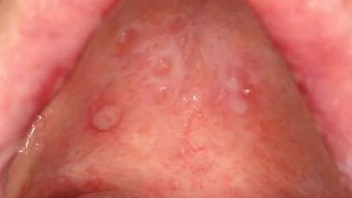 Hình 3. Nhiều u nhầy bề mặt vòm miệng dạng lưới ở một bệnh nhân mắc bệnh mảnh ghép chống ký chủ mãn tính