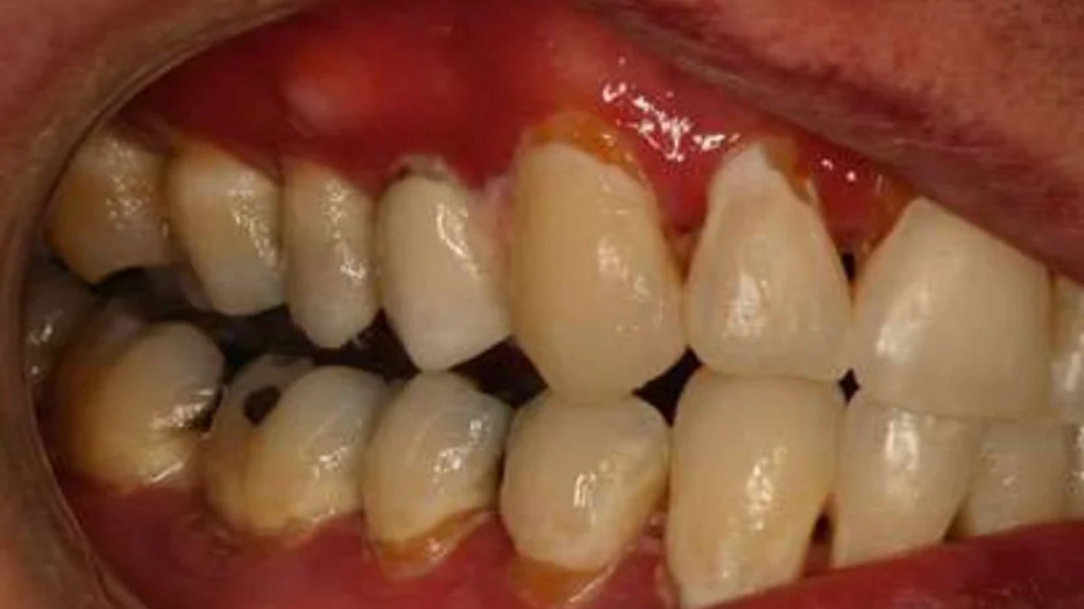 Hình 4. Sâu cổ răng lan rộng ở một bệnh nhân có bệnh mảnh ghép chống ký chủ mãn tính ở niêm mạc miệng