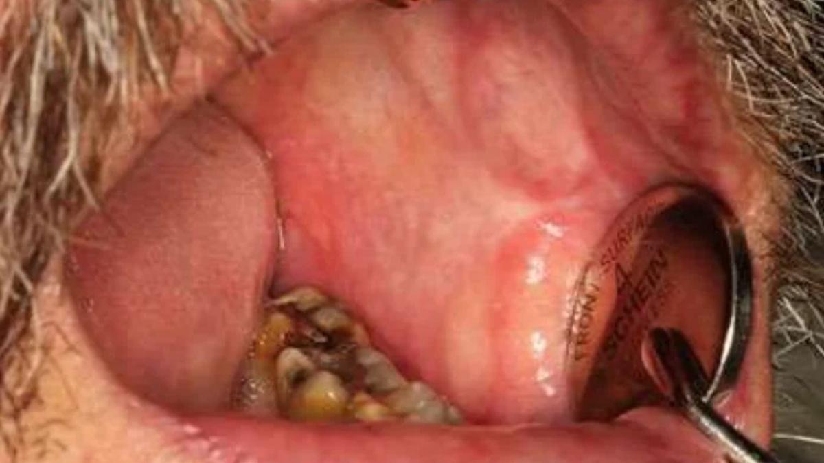 Hình 5. Sự hình thành dải xơ lan rộng của niêm mạc miệng với việc há miệng hạn chế ở một bệnh nhân bị bệnh GVHD niêm mạc miệng mãn tính lâu ngày và khá nặng