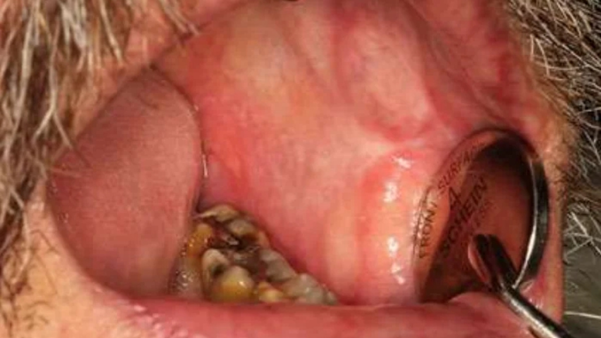 Hình 6. Ung thư biểu mô tế bào vảy xâm lấn của niêm mạc miệng bên trái phát sinh ở một bệnh nhân mắc GVHD mãn tính niêm mạc miệng lâu năm.