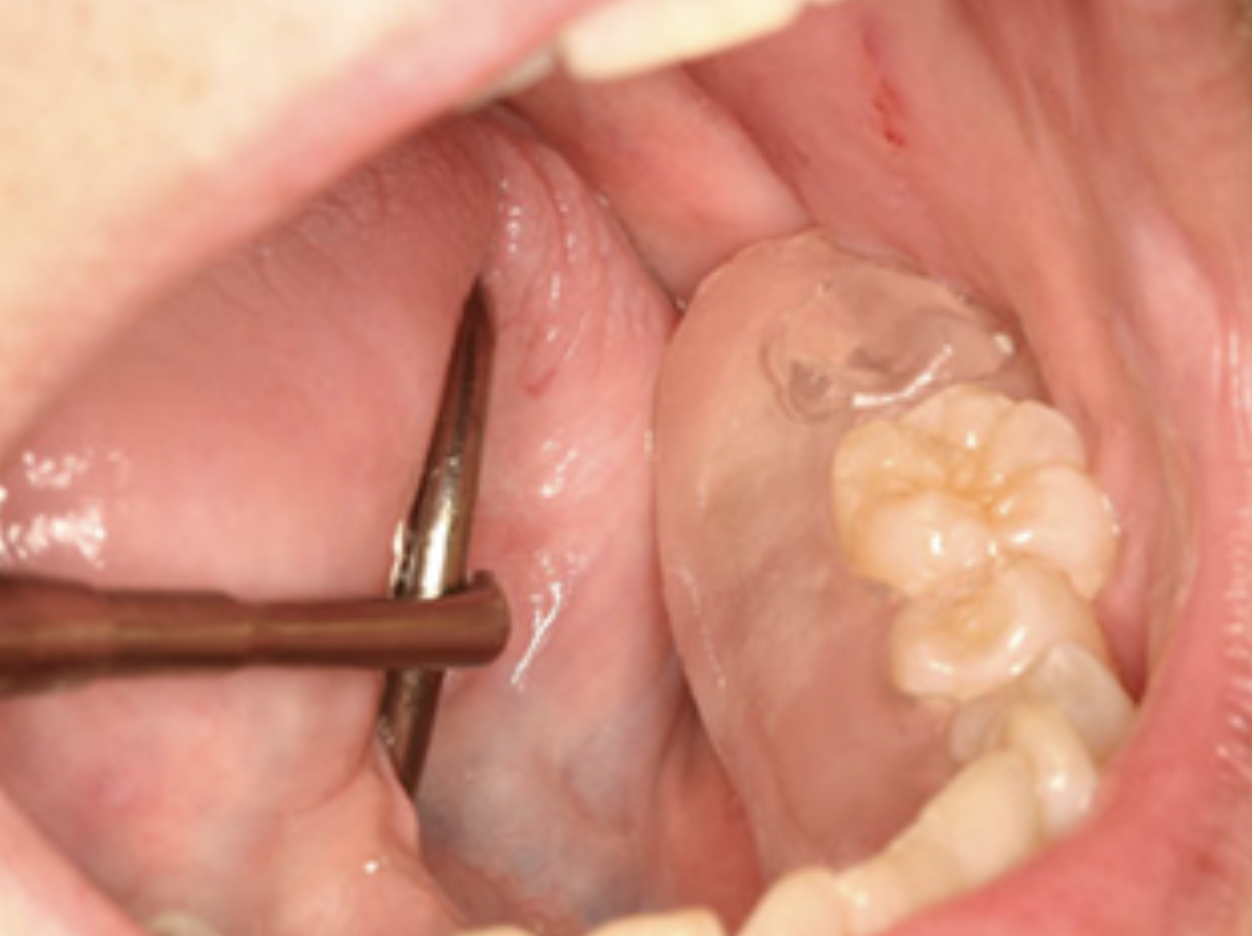 Hình 6. Đặt stent acrylic bảo vệ trên vị trí nhổ răng ở bệnh nhân (Hình 12.3) để ngăn thức ăn, giảm lực tác động và kích ứng mô mềm.