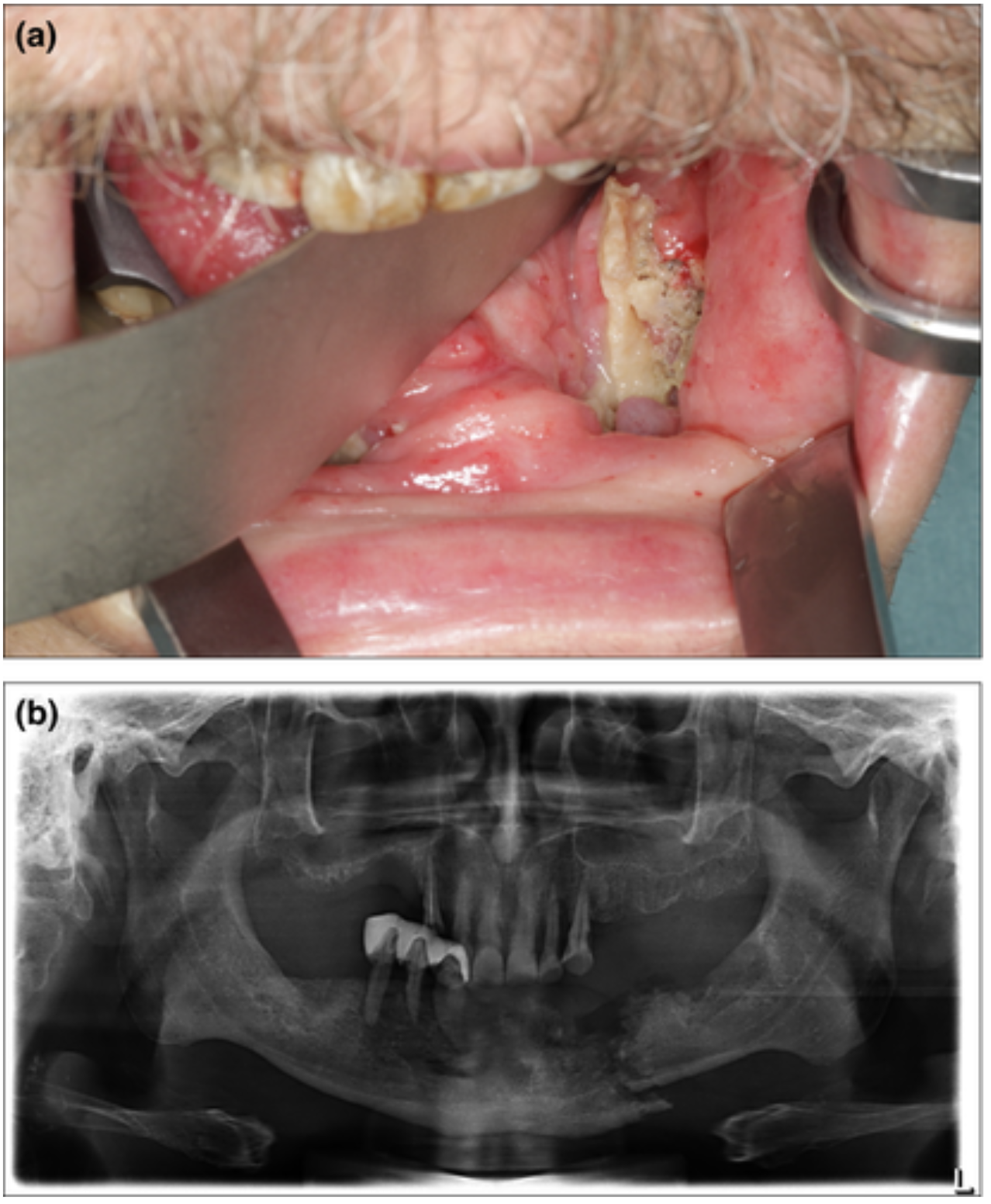 Hình 5. Hoại tử xương hàm do xạ trị